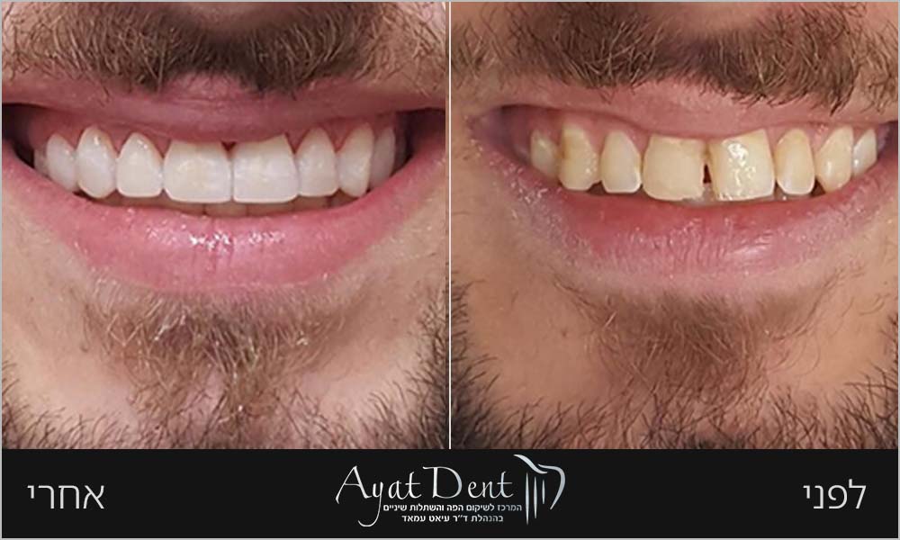 before-after-05