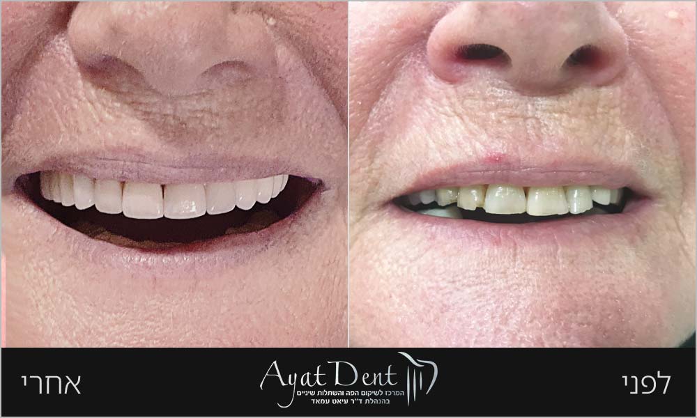 before-after-01a